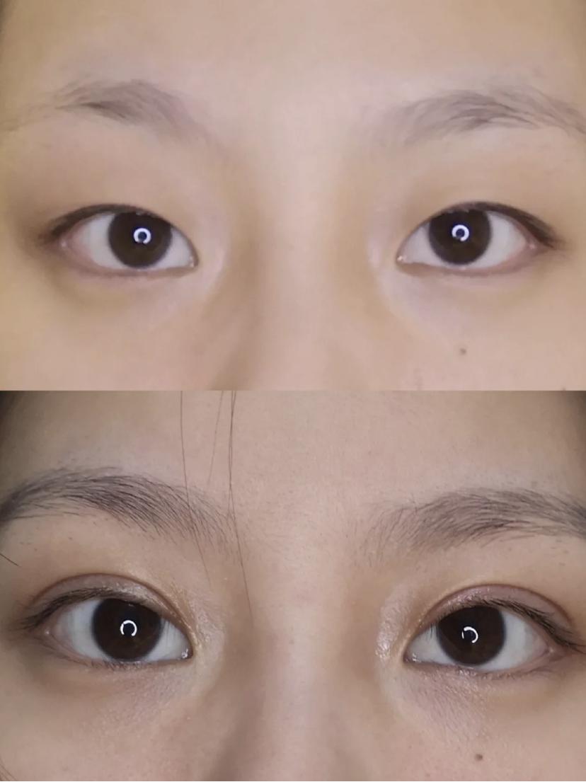双眼皮手术越来越火热丨那么天然的双眼皮和割的双眼皮有什么不同