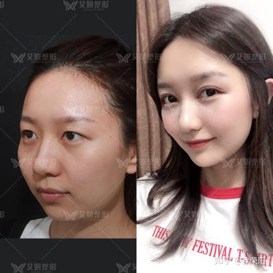 肿泡眼如何改善?