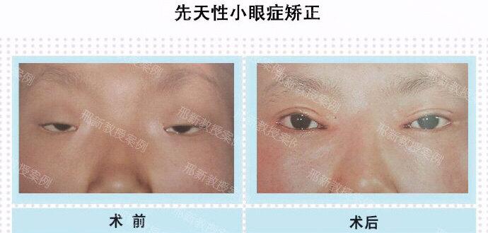 先天性小眼症遗传吗?该如何矫正?