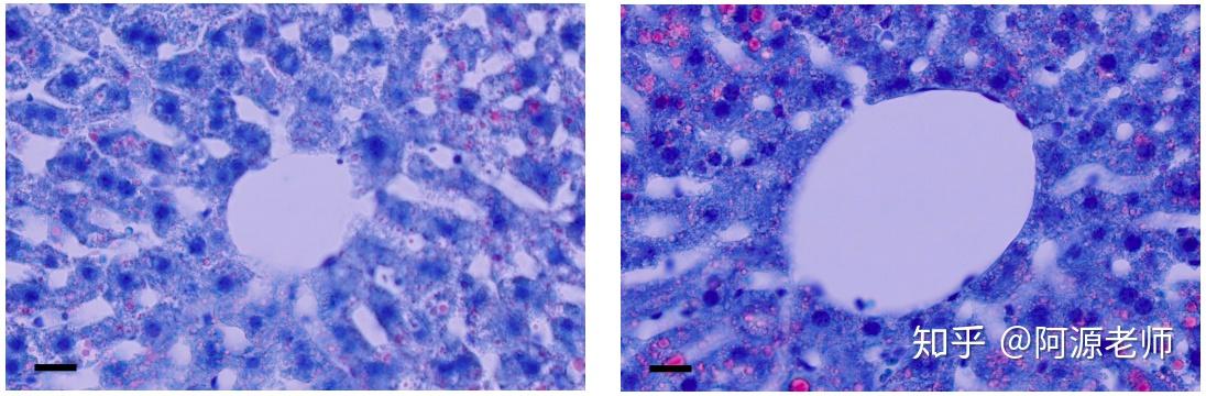 右图为失去睡眠的小鼠肝脏(红色为脂滴)