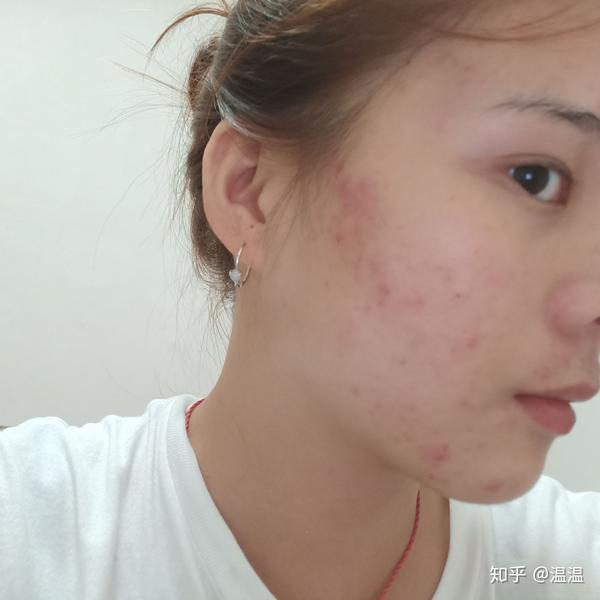 青春期的痘痘能好吗?