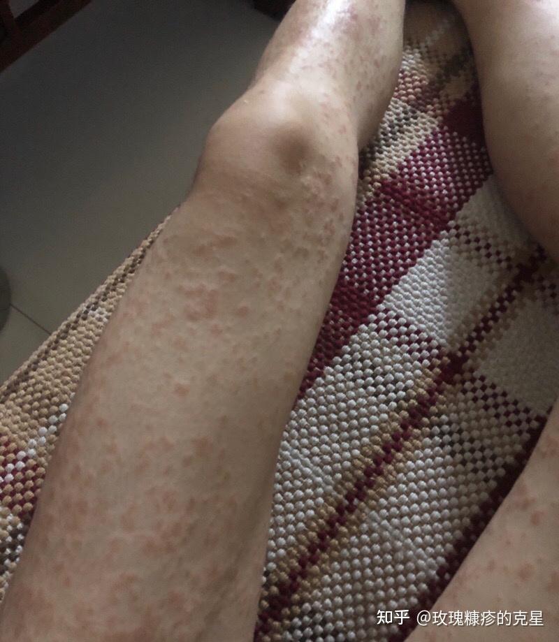 玫瑰糠疹常见的症状有哪些