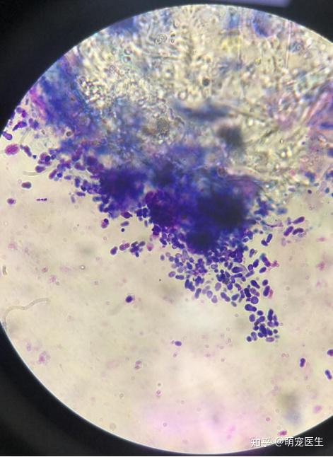 显微镜下耳道马拉色酵母菌