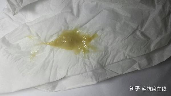 尤其所谓张力性空洞患者; 空洞肺结核 ⑥合并感染时咳嗽且咳痰较多