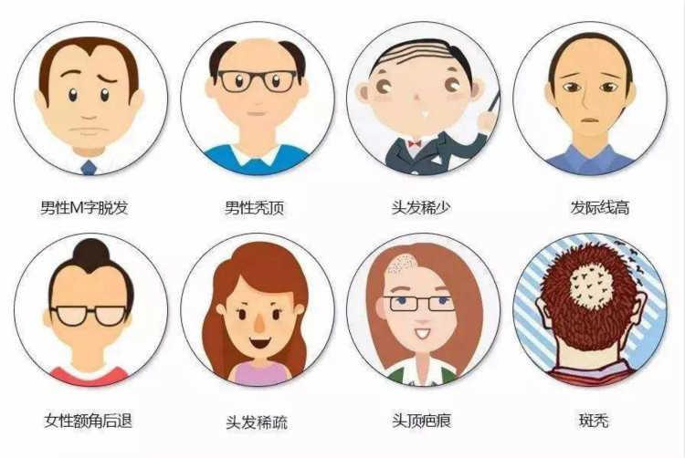 男性脱发治疗的误区