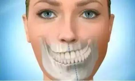 7.后牙锁颌:影响咬合功能,长期导致上下颌骨偏歪畸形.也就是"脸歪"