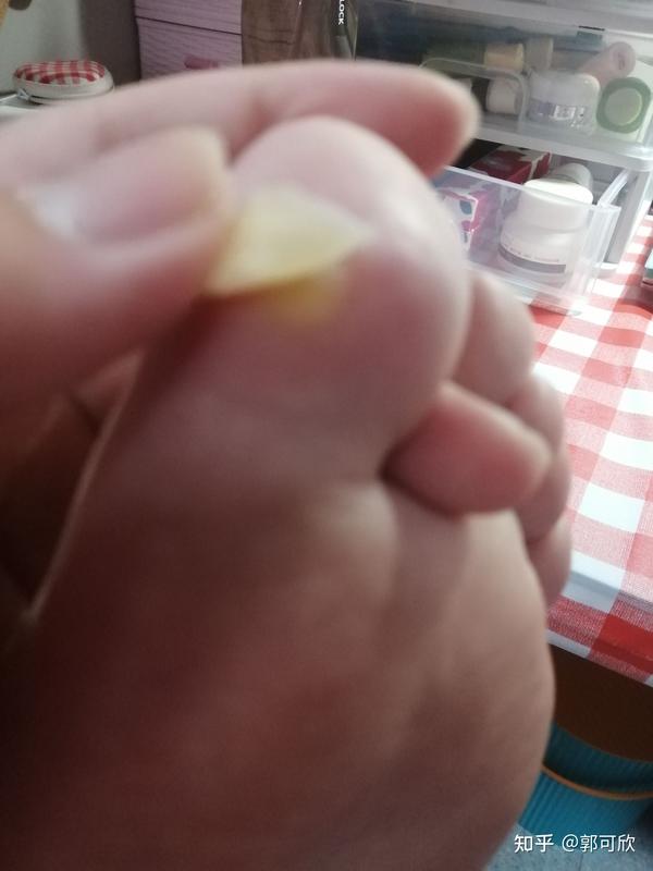 液氮冷冻鸡眼治疗贴.