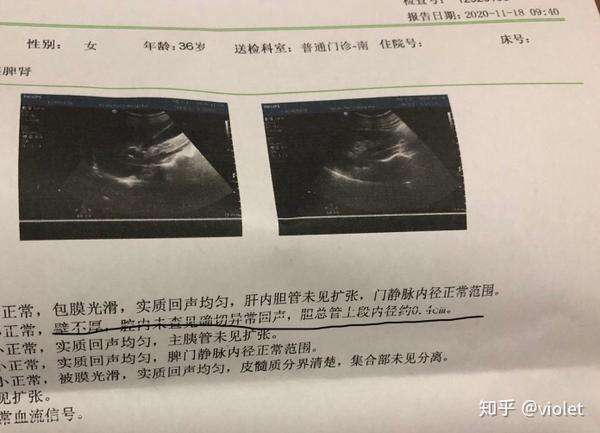 我的胆结石不见了