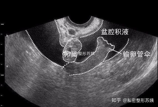 什么是盆腔积液盆腔积液需要治疗么一文解读误区