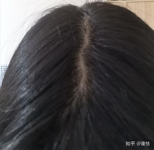 记录一下脂溢性脱发女生用米诺地尔的过程