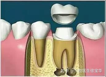 事实上在根管治疗后,没有牙髓提供营养的牙齿会变暗,变脆,剩余的牙冠