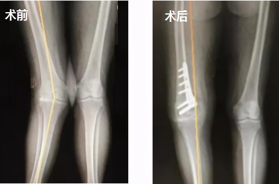 膝外翻畸形疼痛难忍dfo截骨矫形保膝不置换保肢专家文根