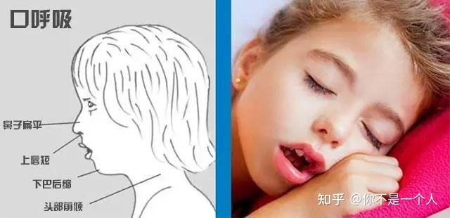 广州圣贝熊飞医生警惕孩子张嘴睡觉别让口呼吸限制了孩子