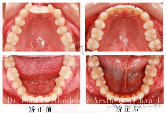 内倾型深覆合牙齿重度拥挤下颌后缩矫正后牙齿排列良好咬合关系为完全