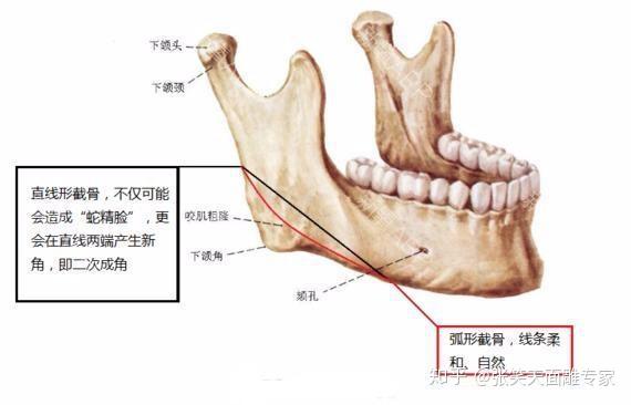 下颌角整形,是通过截骨 磨骨结合的方式改变下颌角的角度,位置和大小