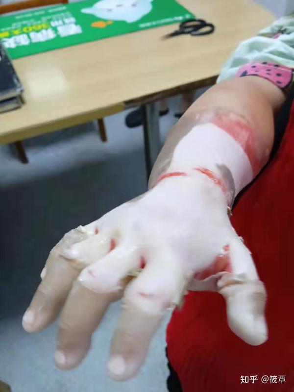 有没有医生可以帮忙看看小孩被开水烫伤成这个样子,可以治好吗