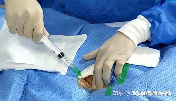 子宫肌瘤不开刀一针见效不留痕