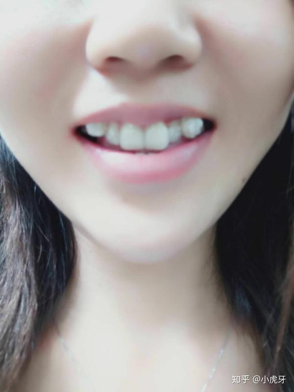 带隐形牙套是什么体验?25岁以上矫正牙齿还有效果吗?需要拔牙吗?