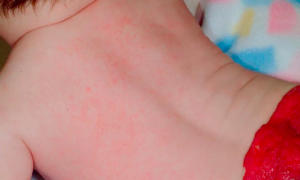 湿疹,尿布疹,过敏.宝宝春季皮肤大爆发,一篇教