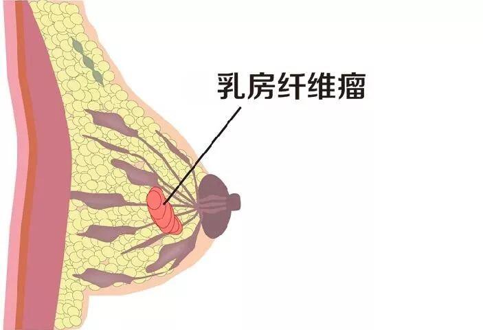 乳腺纤维腺瘤对女性的危害有哪些