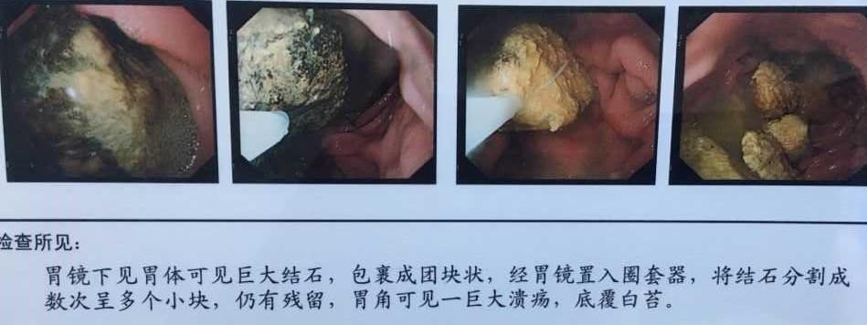 胃柿石 知乎