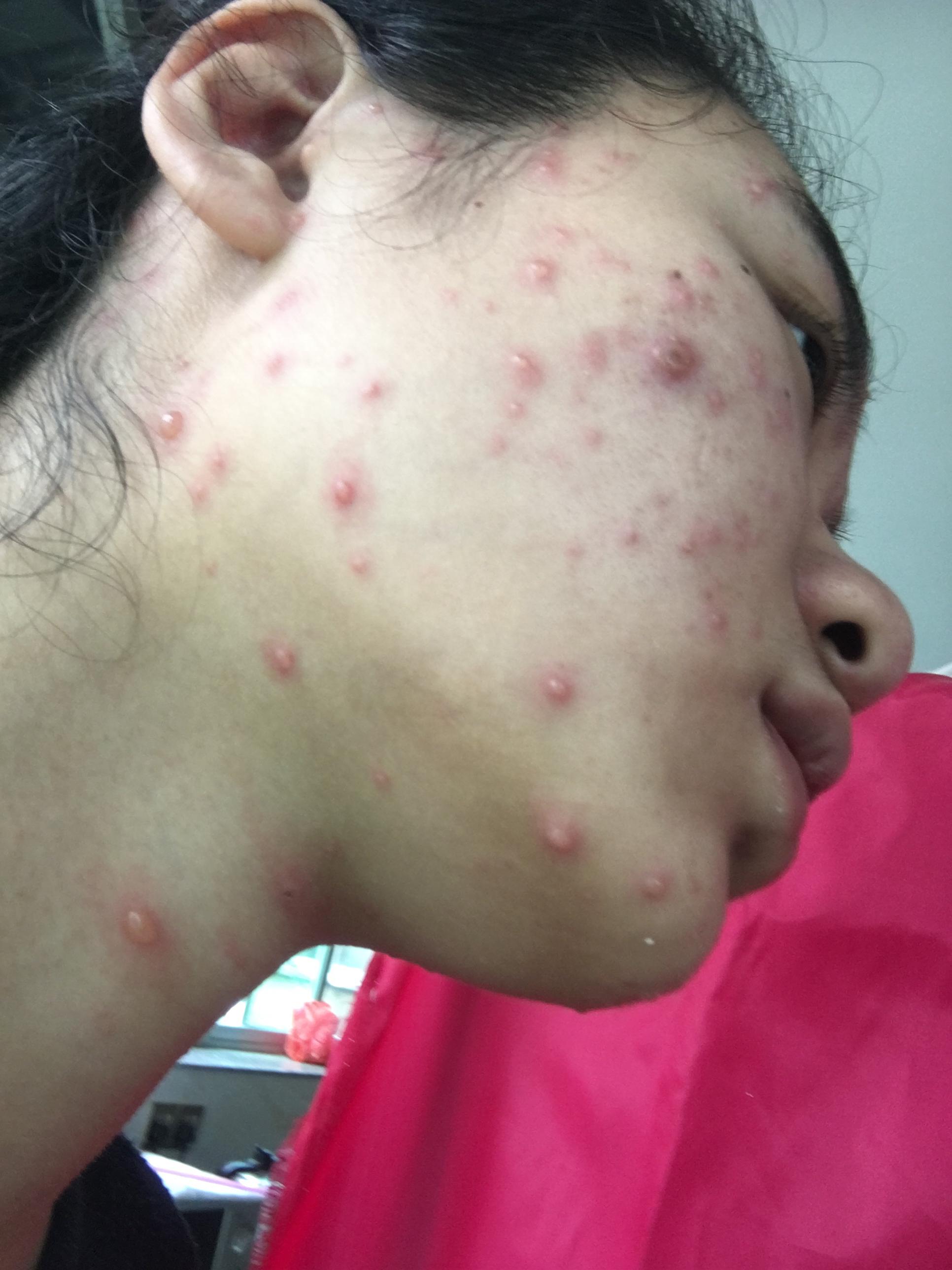 密集恐惧症慎入 吃完午饭在宿舍床上睡觉的时候发现肚子上一颗大痘痘