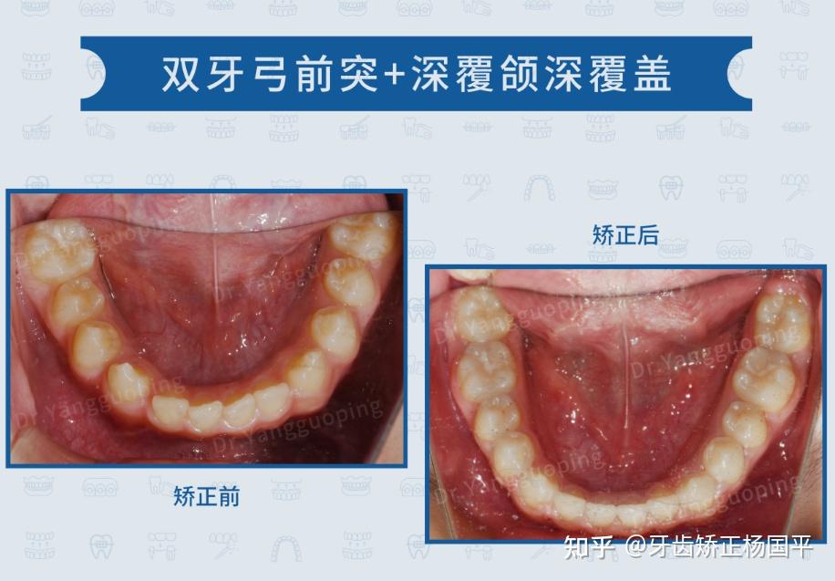 这位患者上下牙弓前突并且伴随重度深覆颌深覆盖,牙列散在间隙,侧貌