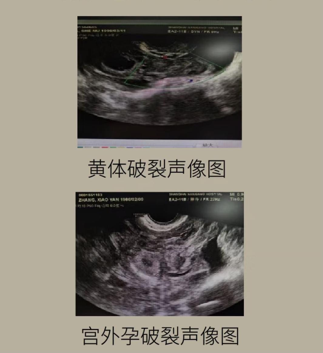 此时,黄体破裂超声图像与宫外孕破裂超声图像,极其相 ..