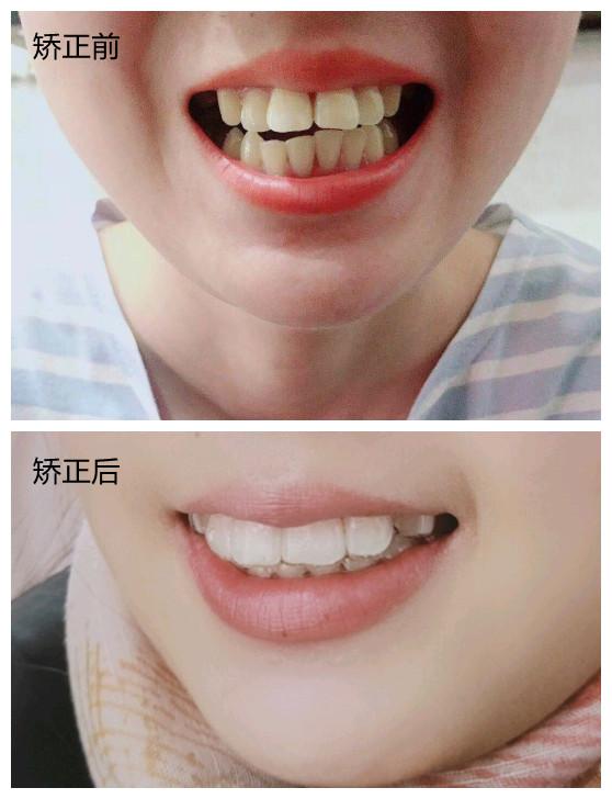 成都牙齿矫正(正畸)【案例】—牙齿前突 牙列不齐
