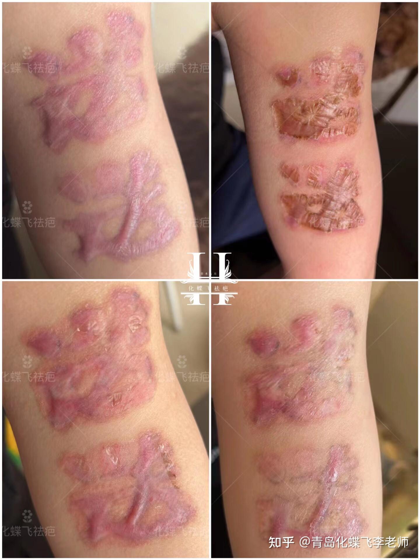 山西洗纹身导致的增生疤痕