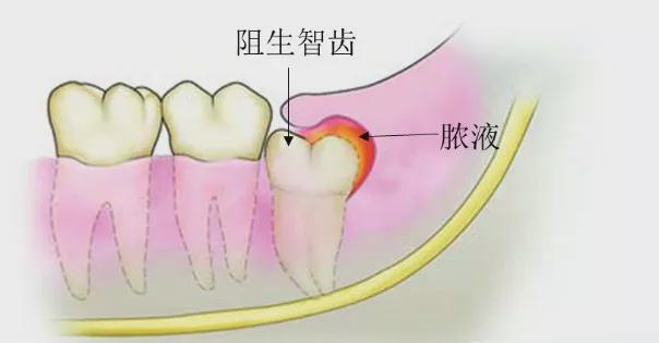 廊坊长智齿一定要拔吗关于智齿的真相看这里