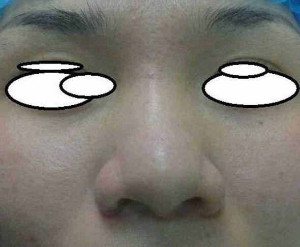 鼻梁做了假体再做鼻头鼻翼需要取出之前的假体吗