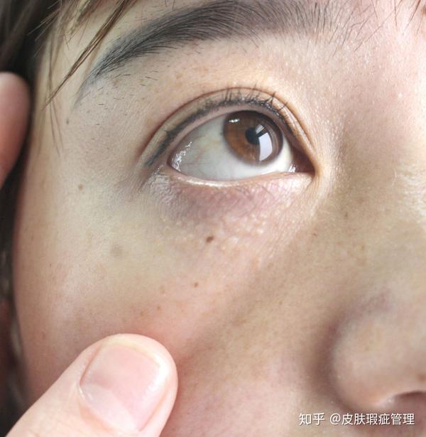 眼睛周围长汗管瘤是什么原因造成的?