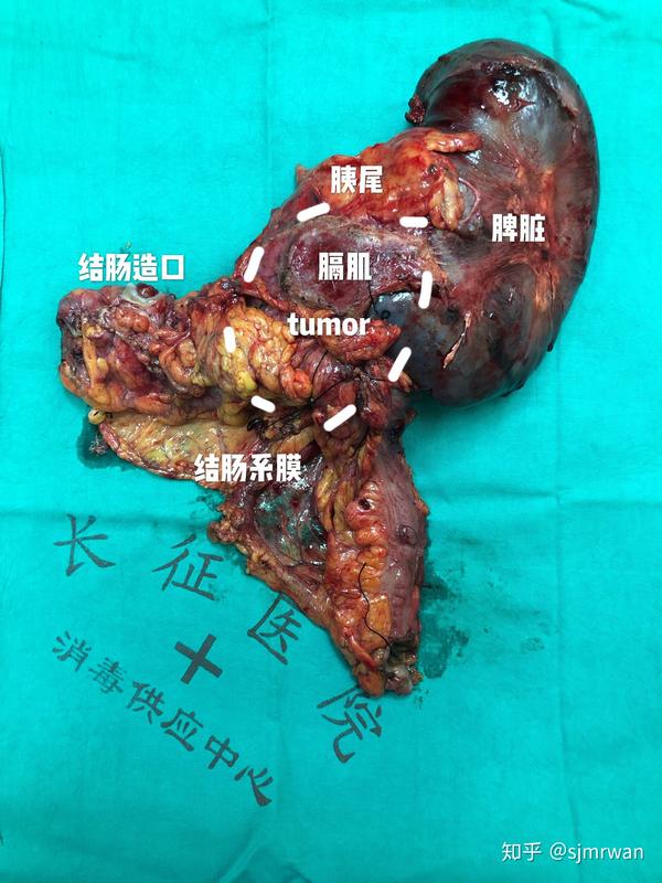 结肠恶性肿瘤侵犯脾脏,胰腺,胃,膈肌