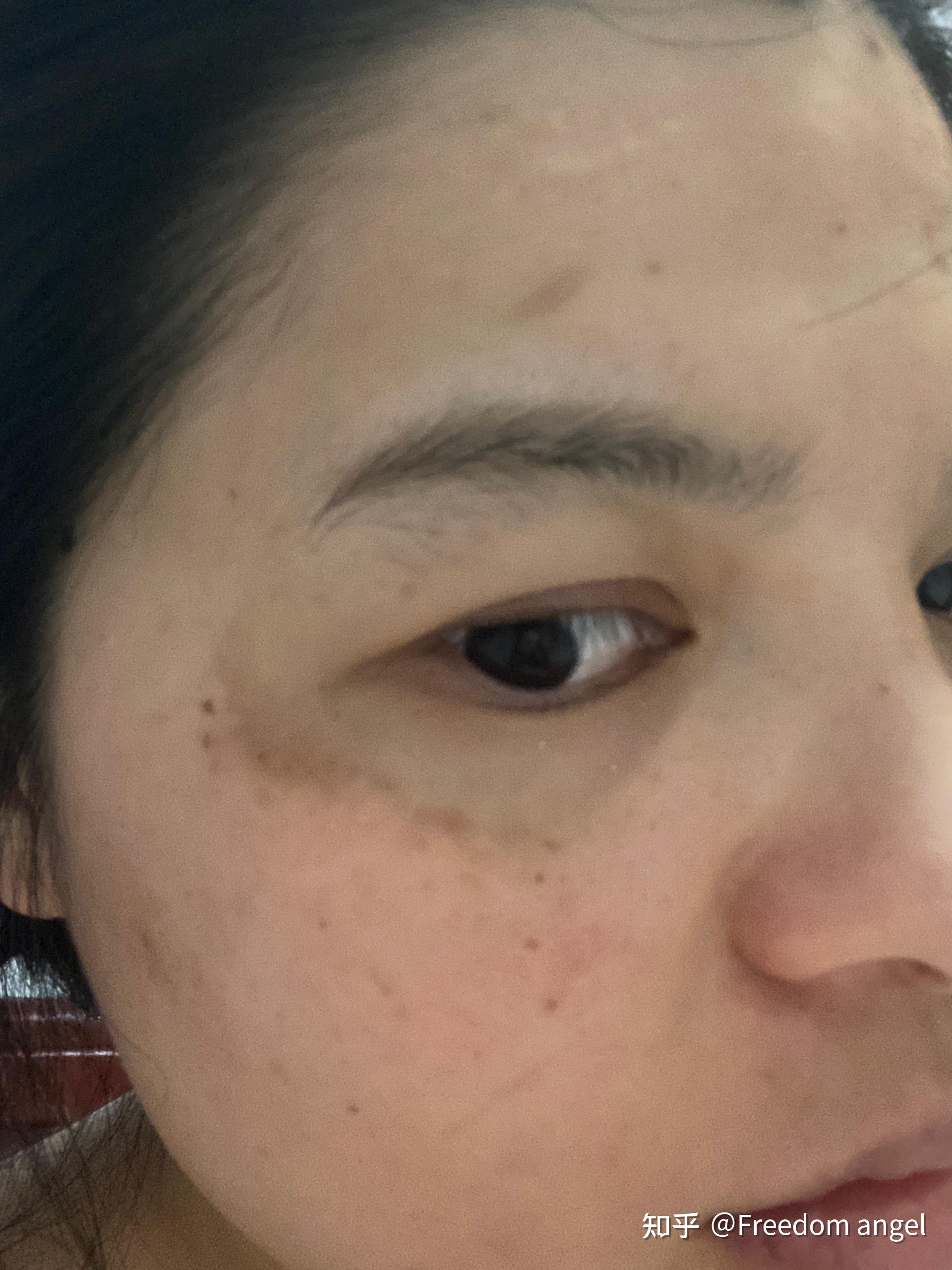 谁知道去掉面部黄褐斑最好的方法