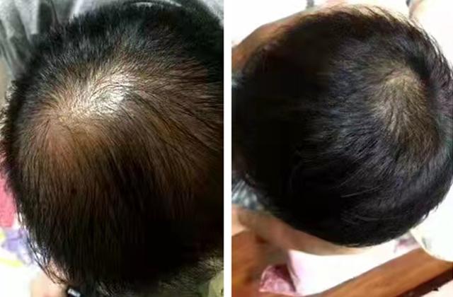 脂溢性脱发怎么调理脂溢性脱发能不能治疗好