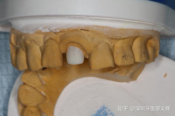 前牙折断,氧化锆桩,全瓷冠修复一例