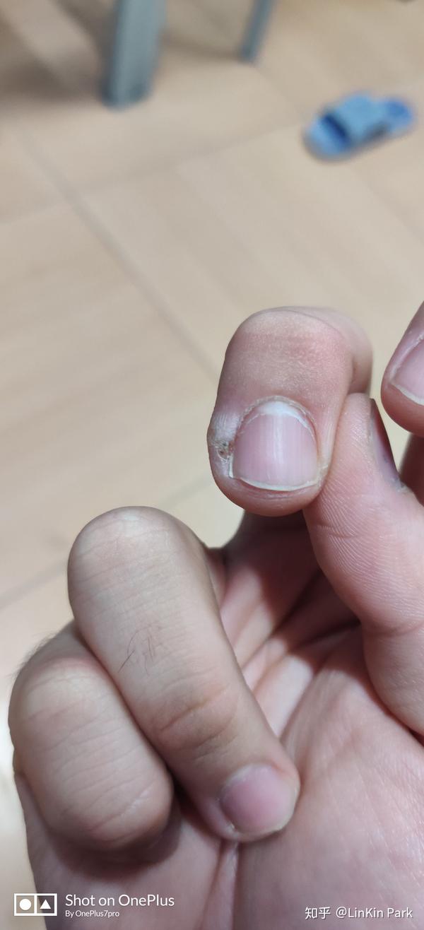 我手上这个是鸡眼吗?