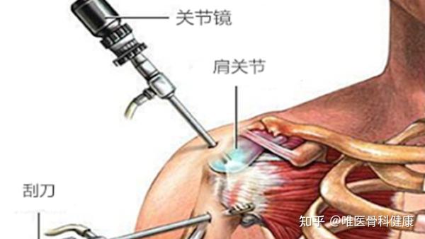 结构解剖异常者,均考虑手术去除肩峰下撞击综合症病因,如行肩峰成形术