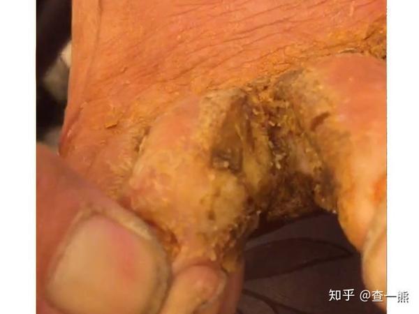 图五  糜烂消失,趾间皮肤腐肉祛除