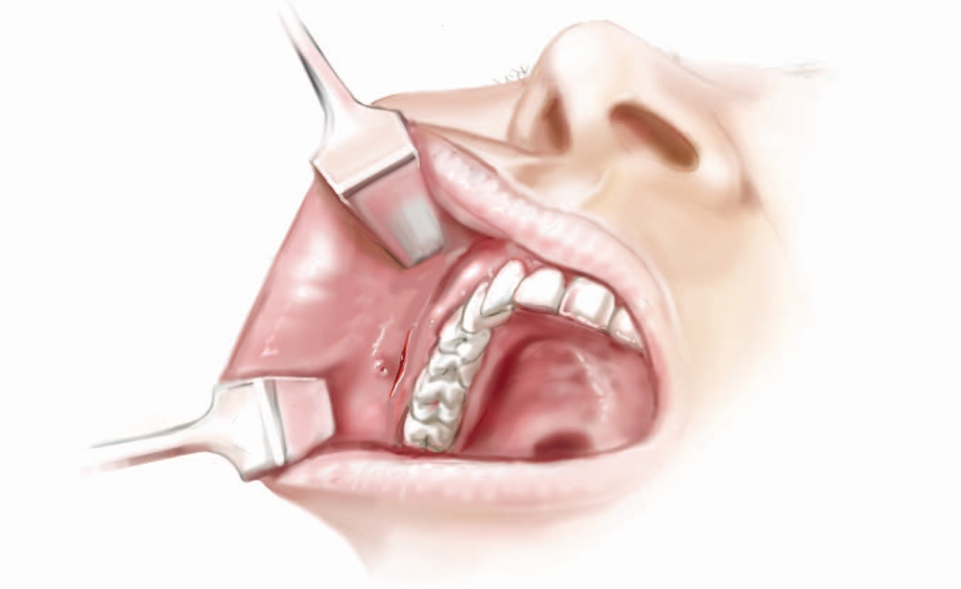 下颌角手术改善,单纯磨骨与下颌骨截骨手术应该如何选择?