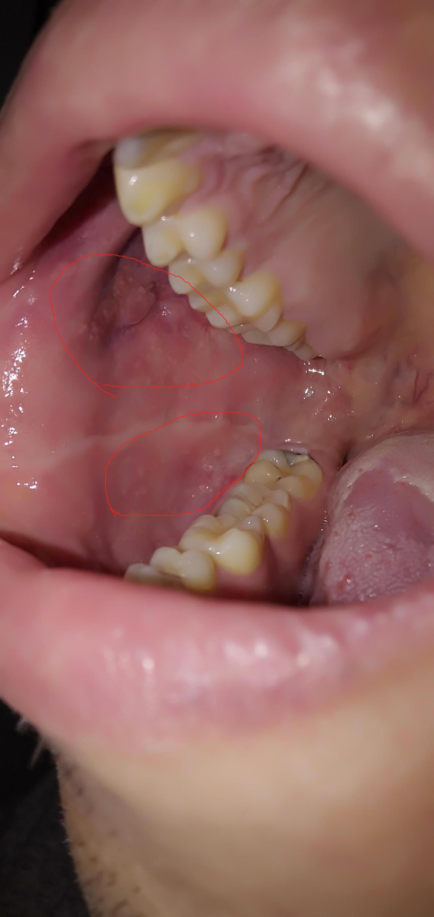 嘴巴口腔内壁两侧有一些小颗粒,请问这是什么原因!