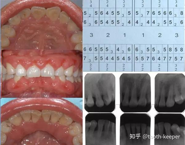 慢性牙周炎伴药物性牙龈增生随访八年病例一例