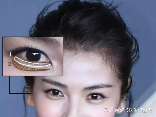 眼袋和卧蚕有什么区别吗