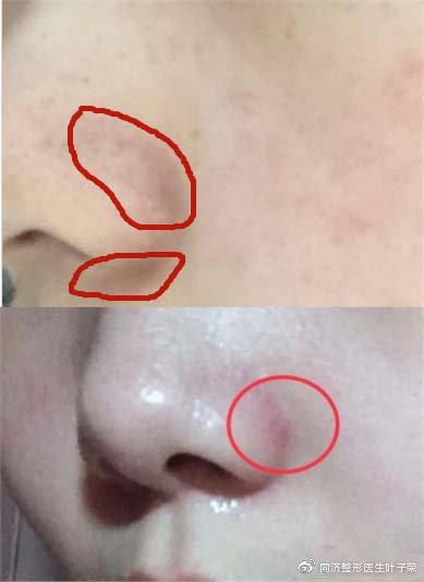 鼻翼泛红就是脂溢性皮炎