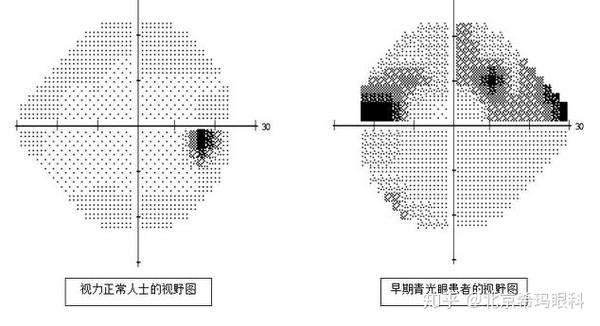 青光眼诊断和监察的主要指标包括:(1)视力,(2)视野,(3)眼内压,(4)视