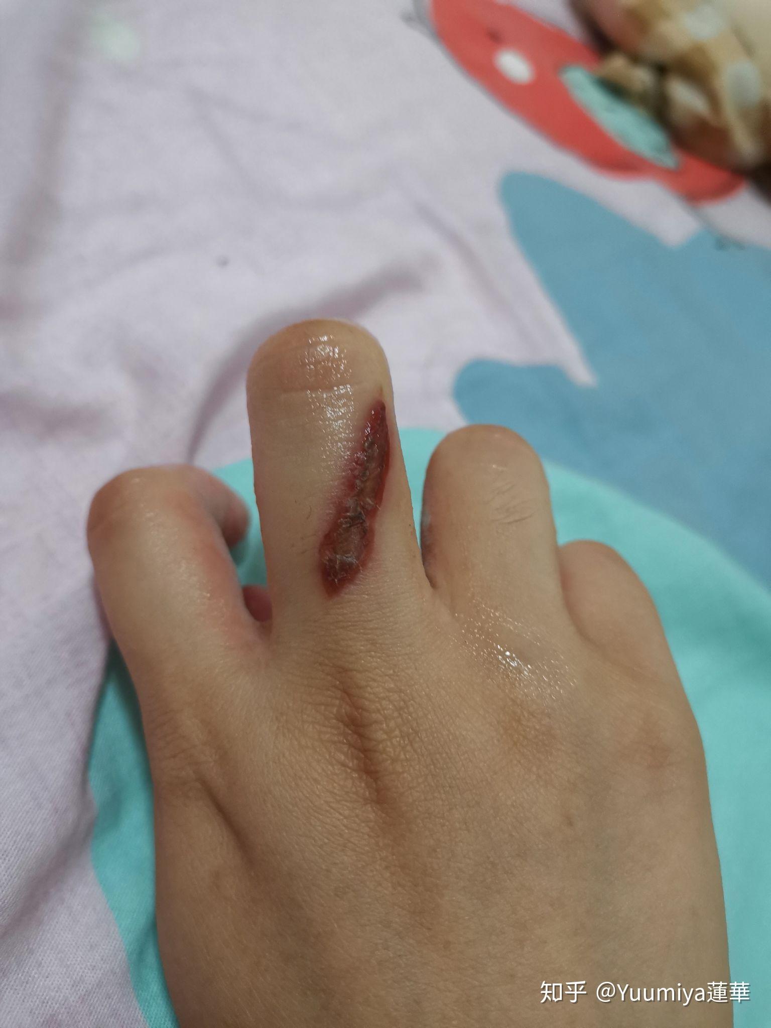 被电烙铁烫伤是一种什么样的体验怎么处理不易留疤
