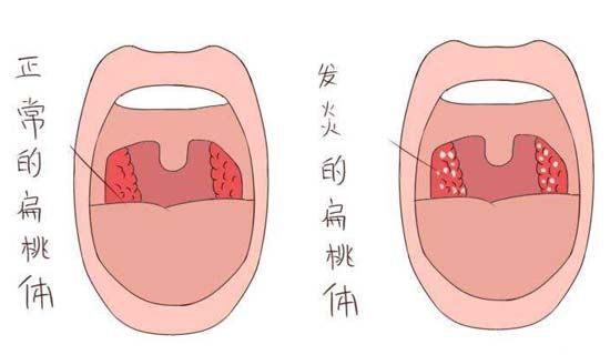 扁桃腺炎引起慢性肾炎?