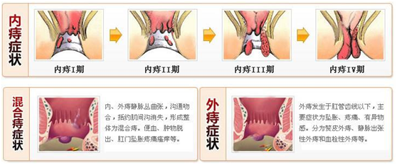 痔疮初期症状