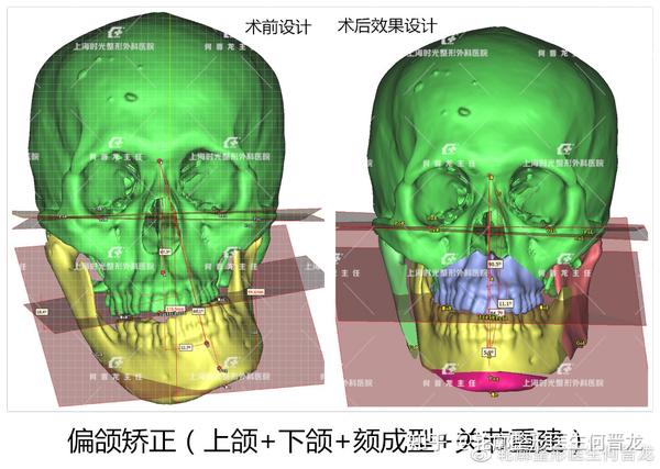 进行性半侧颜面萎缩畸形